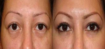 Important Facts About Eyelid Retraction
