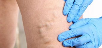 Get the best Endovenous Laser Ablation Treatment at Gilvydis Vein Clinic in Illinois