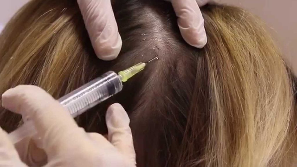 FAQs On Mesotherapy For Hair Loss