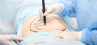 Your Complete Guide to Liposuction Recovery