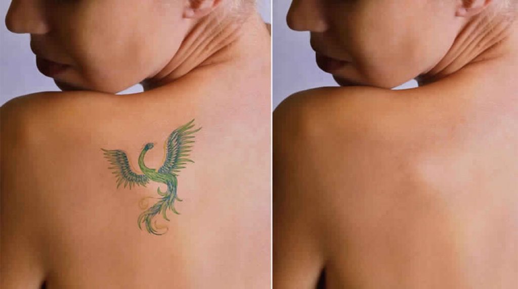 Laserless Tattoo Removal