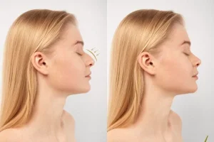 rhinoplasty price