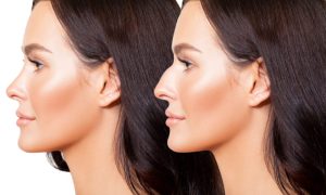 rhinoplasty price